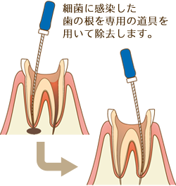 根管治療