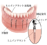 ミニインプラント 