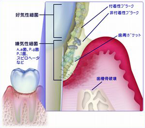 歯周病