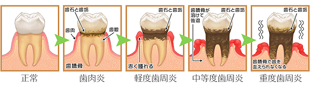 歯周病の進行