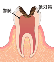 Ｃ３：神経まで達した虫歯