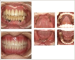 入れ歯に応用