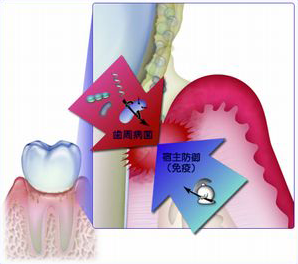 歯周病と免疫