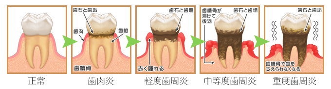 歯周病の進行